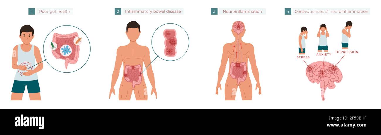 Poor gut health leads to chronic inflammation, which in turn leads to neuroinflammation, which can cause stress, anxiety, and depression. Vector illus Stock Vector