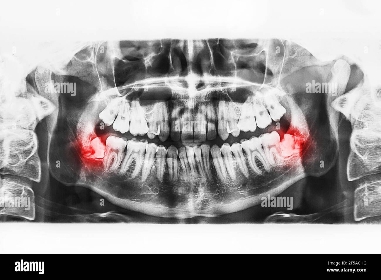 X-ray image of oral cavity with growing lower wisdom teeth on white background. Stock Photo