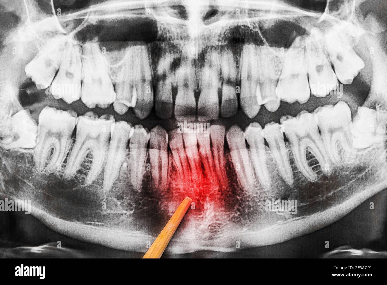 The process of curvature of the teeth in the lower jaw on the Xray image of the oral cavity