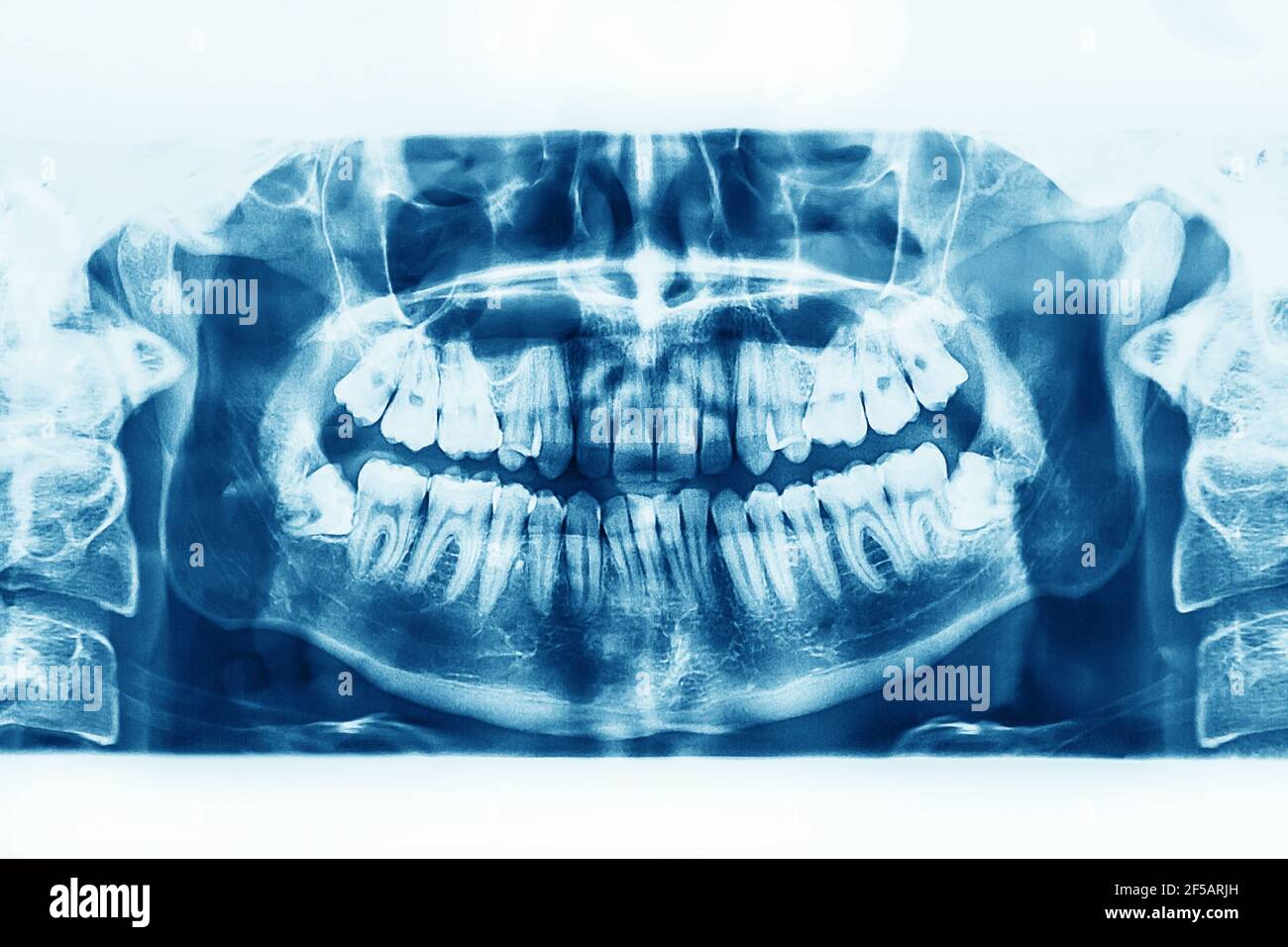 X-ray image of oral cavity with growing lower wisdom teeth on white
