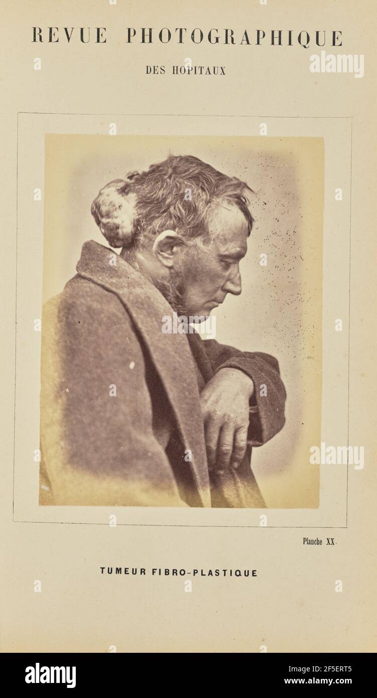 Tumeur fibro-plastique. Arthur de Montmeja (French, born 1841) Stock Photo