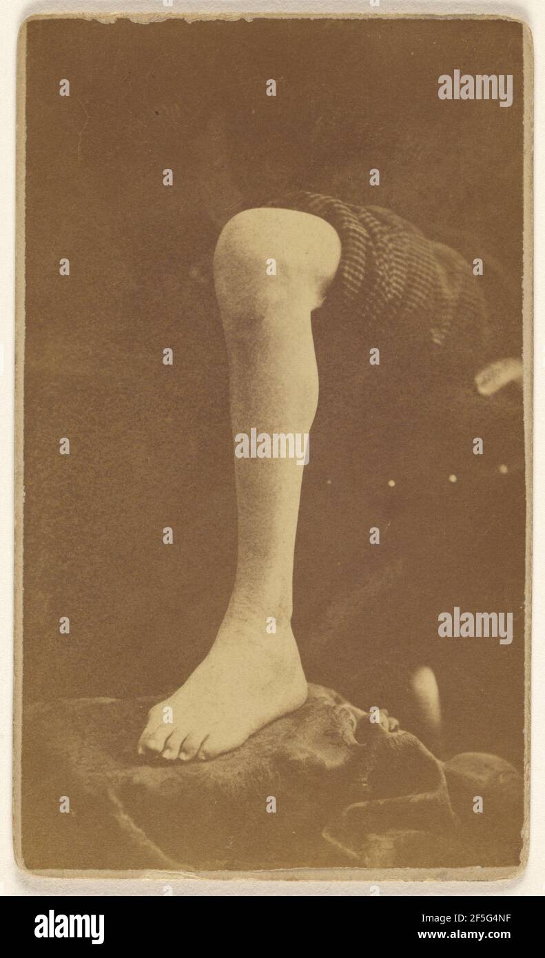 Excision ankle joint Pt. Robert Fuller 45th Ill. Post office Bedford Ohio Civil War victim. J. Dennison (American, active 1860s) Stock Photo