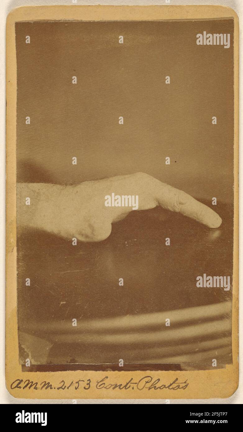 Right hand of Saml. Hagle, wounded at Petersburg (---illeg.) June 17th 1864.. H.D. Ward (American, active North Adams, Massachusetts 1860s - 1870s) Stock Photo