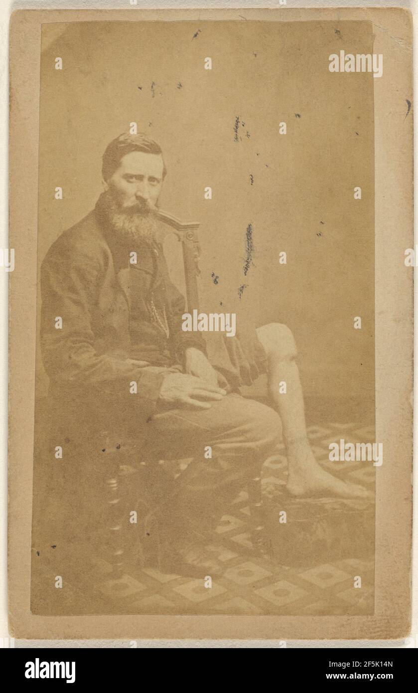 No.5 Case of John Measor U.S.V. Excision of the Tibia.. Unknown maker, American Stock Photo
