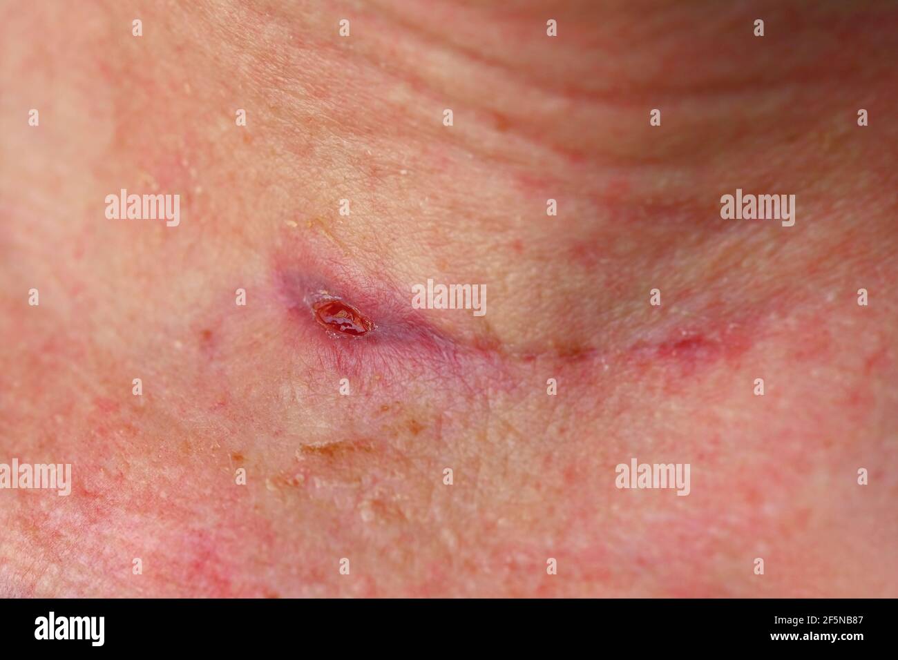 Freshly healed scar on the neck after thyroid surgery. Stock Photo