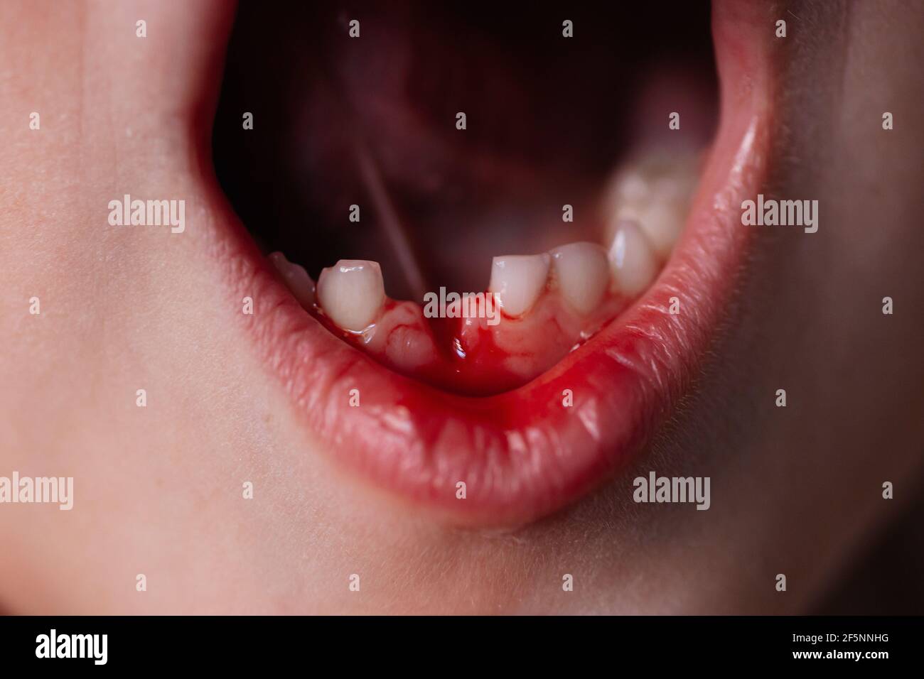 closeup bloody wound in the gum from the first temporary baby tooth