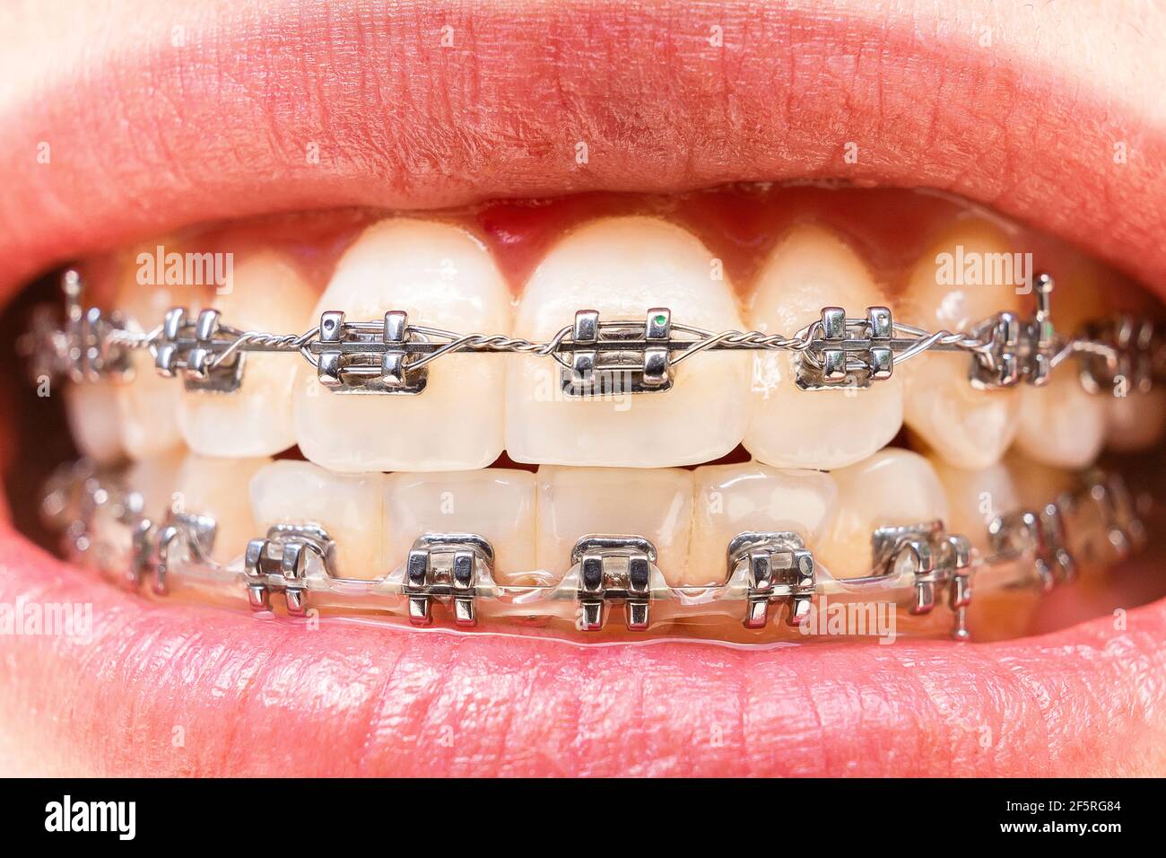 Foreground teeth with braces with traces of food. Dental care photo