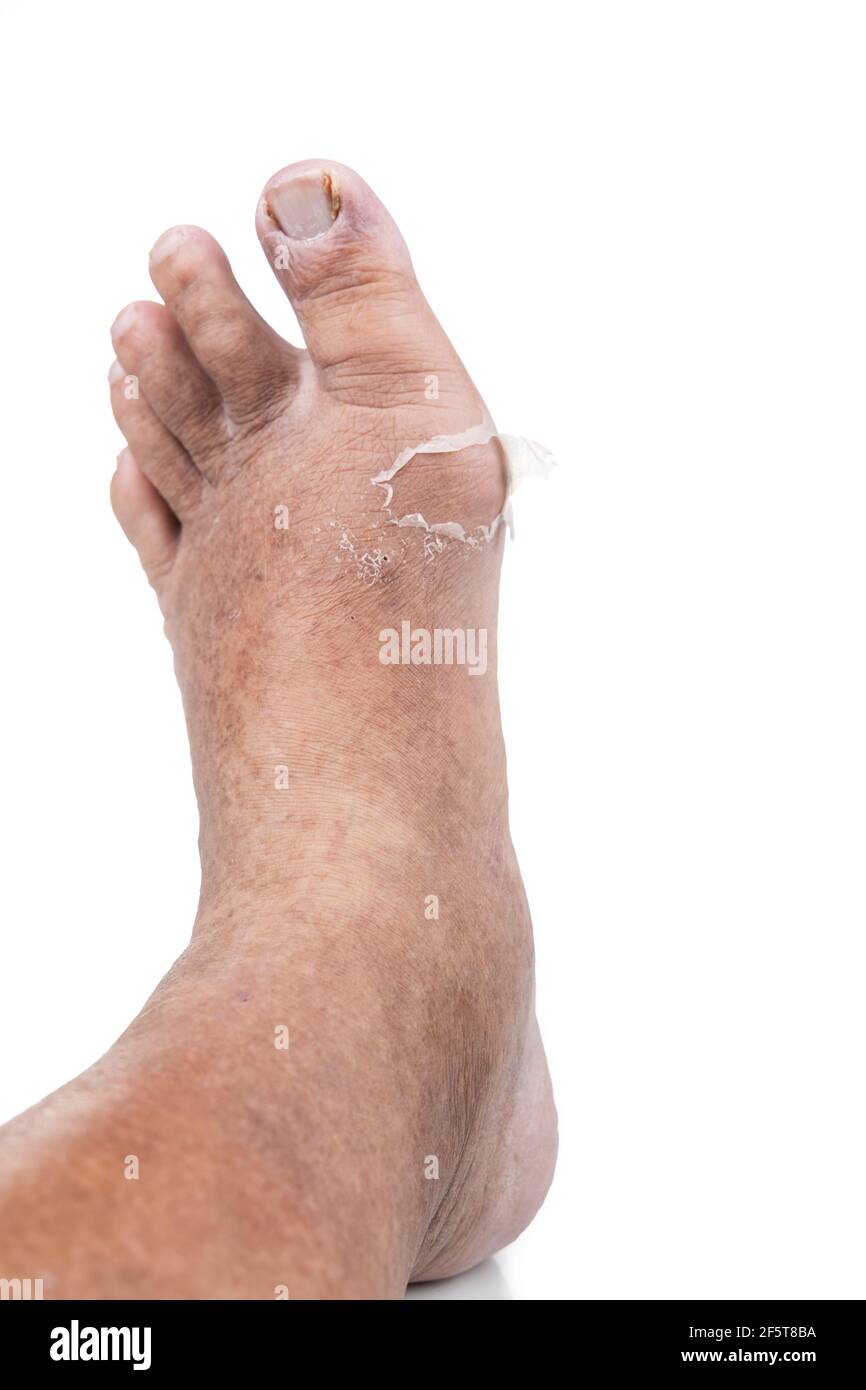 Recovered foot joint from gout attack with old skin peeling off from inflammed area Stock Photo