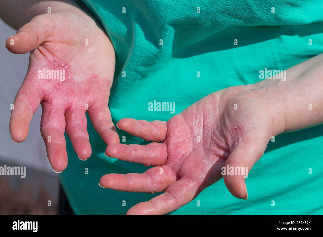 Atopic dermatitis, The woman looks at red and chapped hands with severe allergies Stock Photo