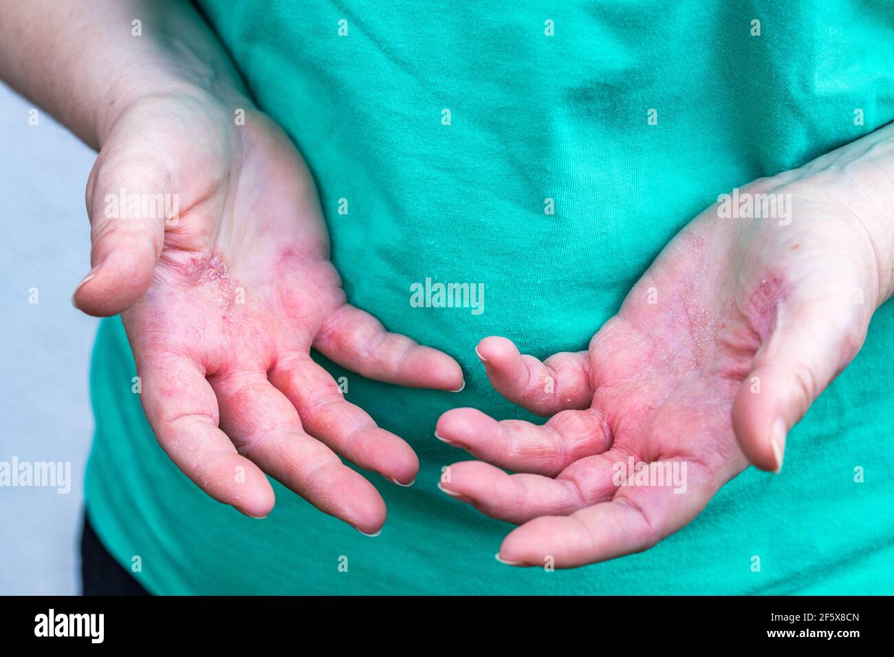 Atopic dermatitis, The woman looks at red and chapped hands with severe allergies Stock Photo