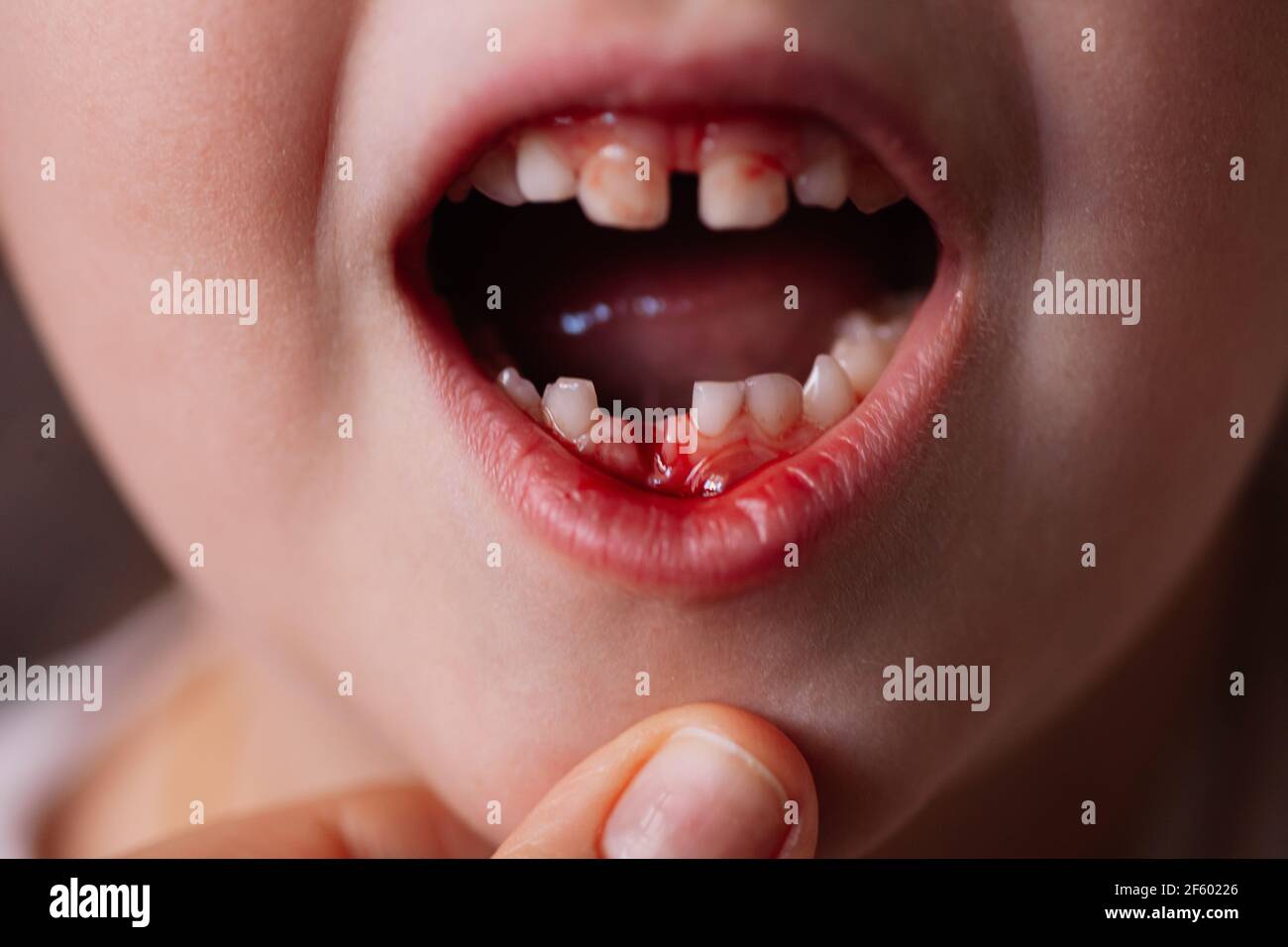 Close Up Of An Open Babys Mouth With Bloody Blisters And Bleeding From