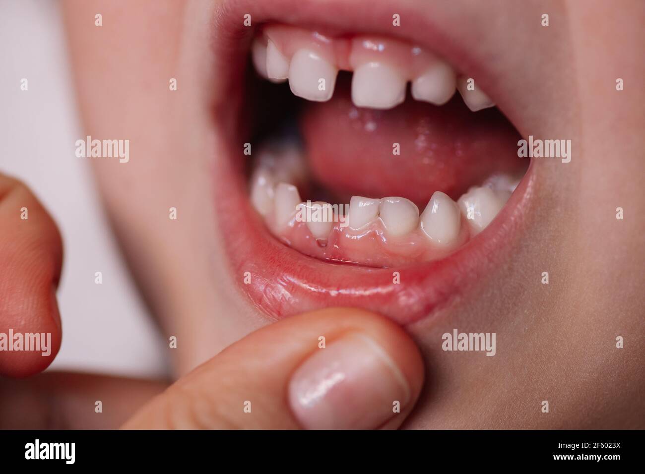 Of tooth poking through gum