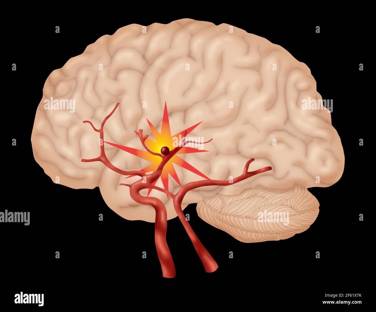 Brain Aneurysm, 3 of 3 Stock Photo