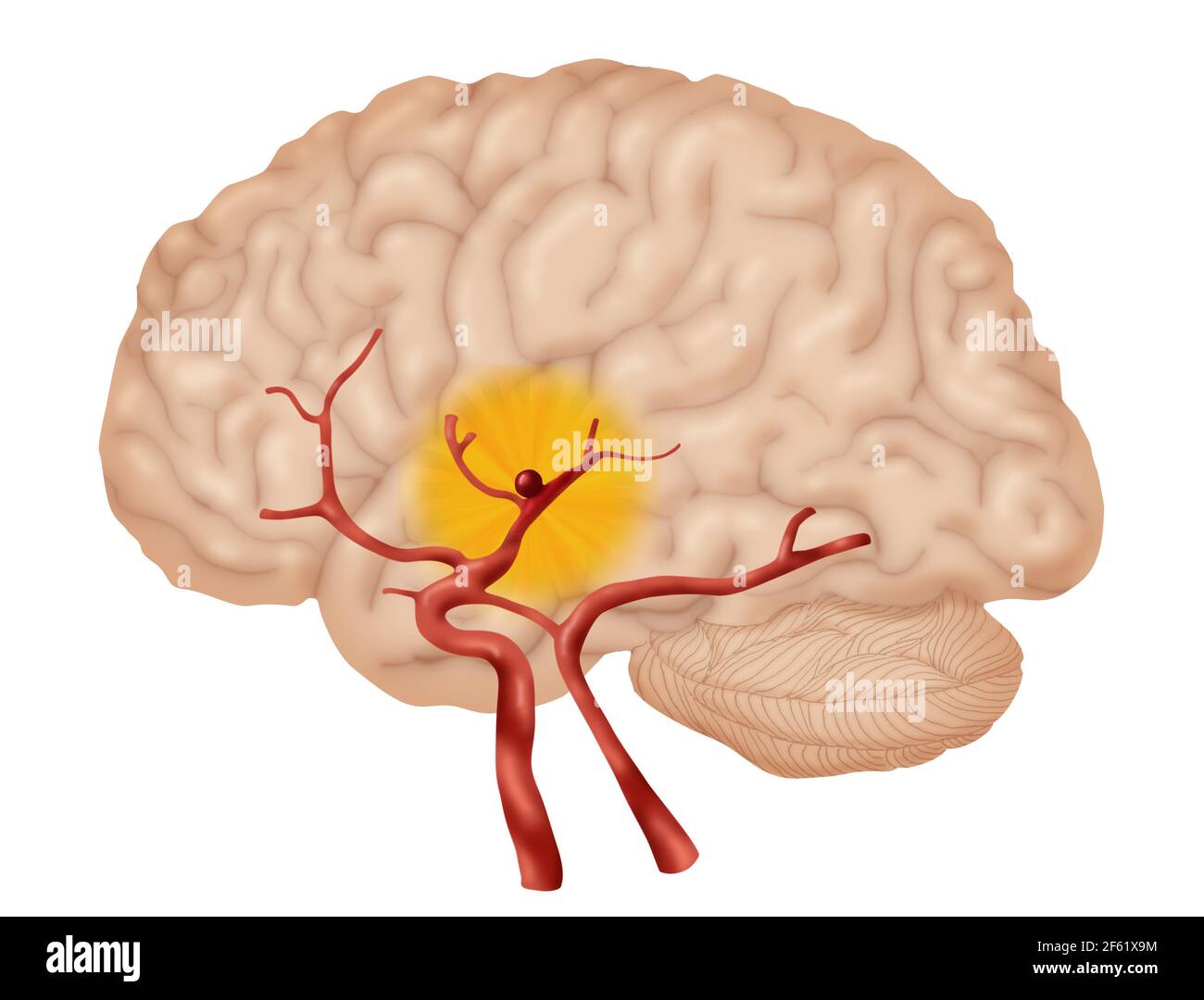 Brain Aneurysm, 2 of 3 Stock Photo