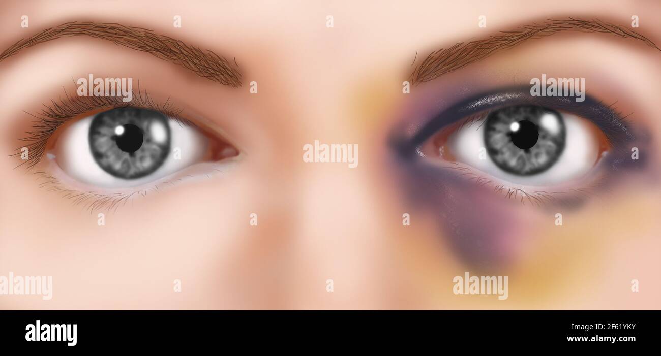 Black Eye Bruise Makeup