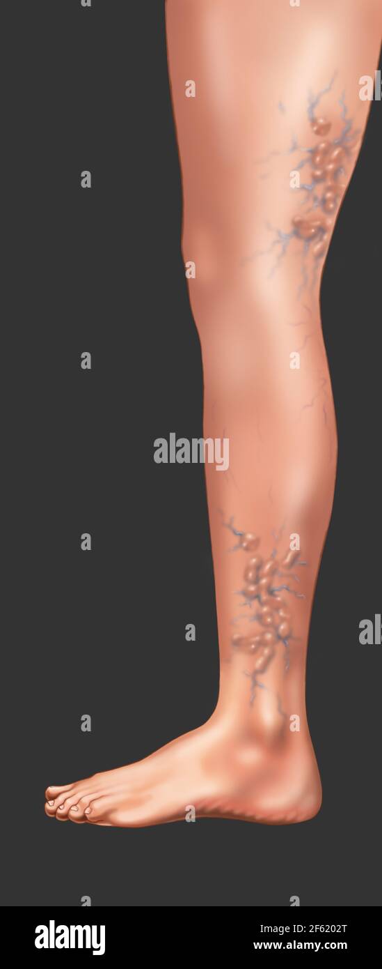 Varicose Veins Stock Photo