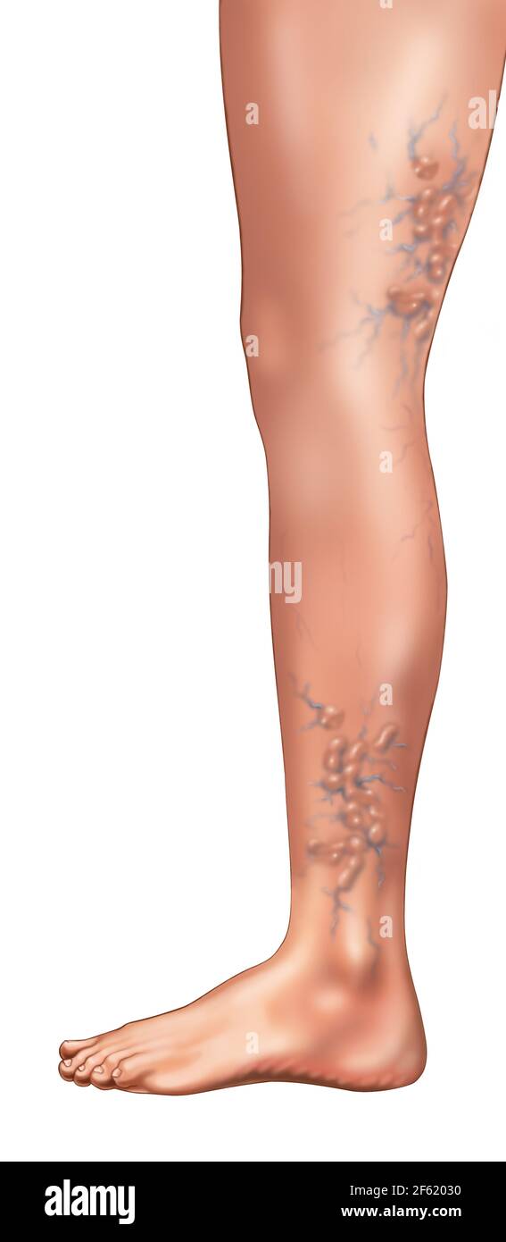 Varicose Veins Stock Photo