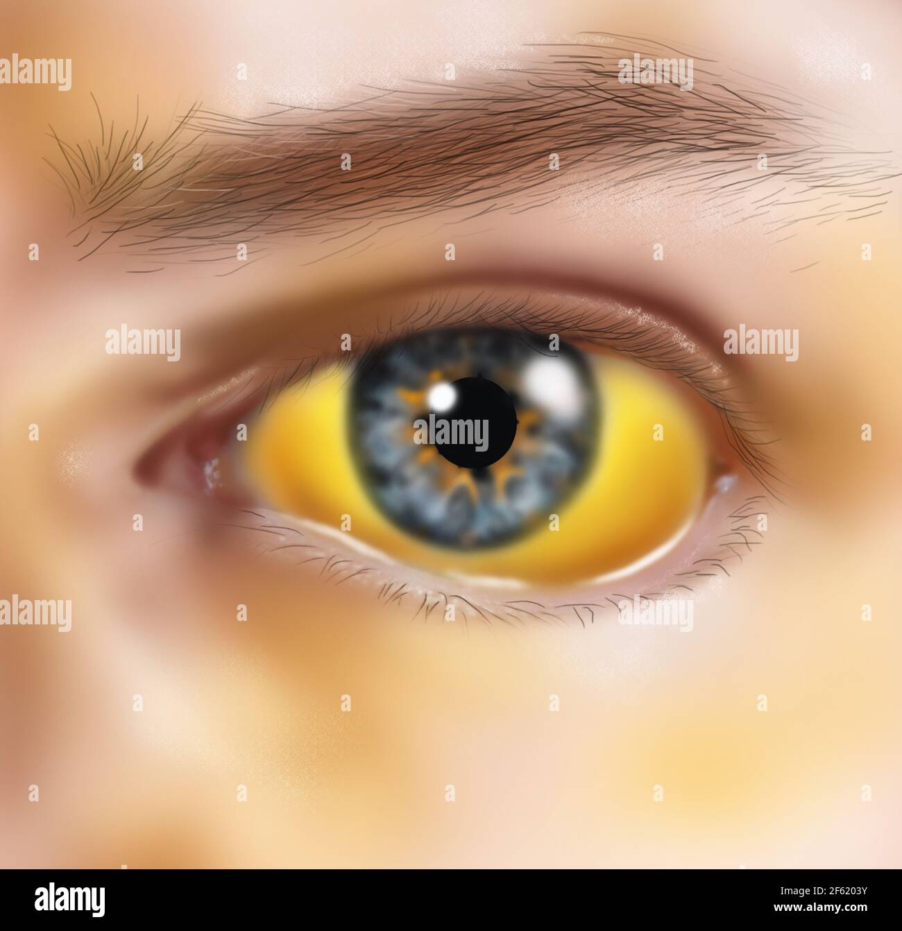 Jaundice skin hires stock photography and images Alamy