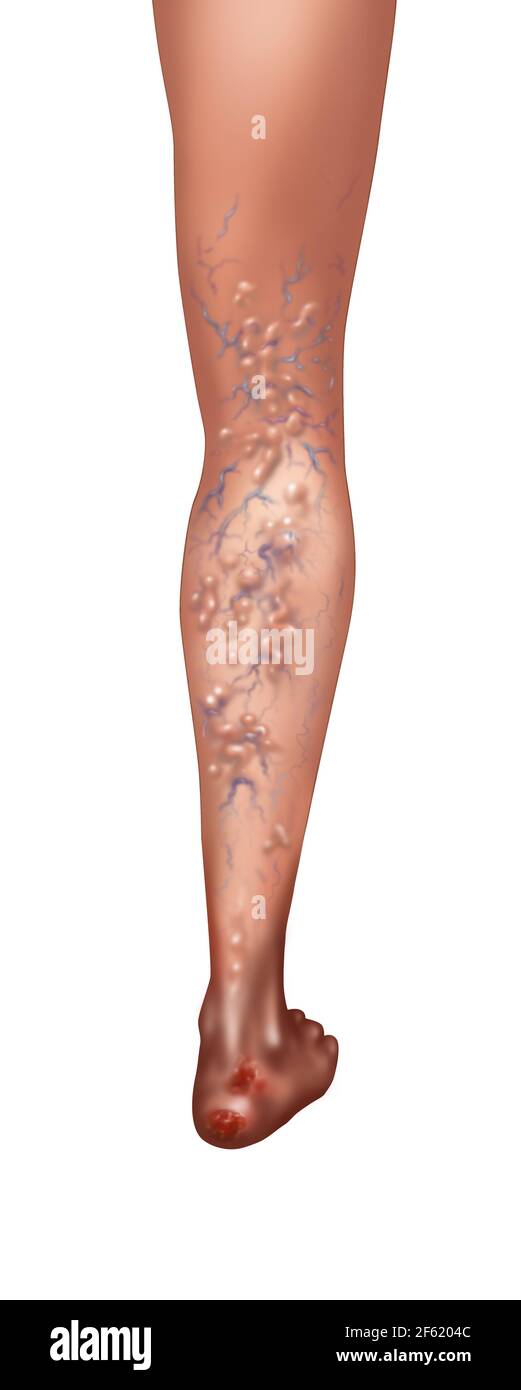 Ruptured vein hires stock photography and images Alamy
