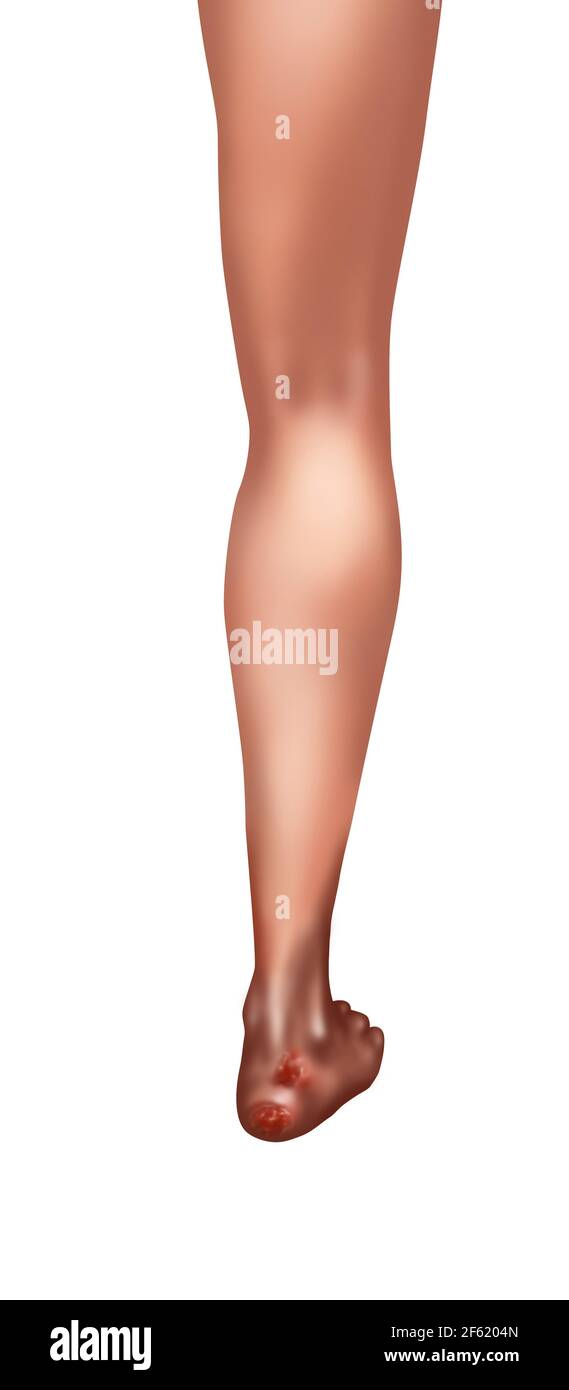 Bed sores hires stock photography and images Alamy