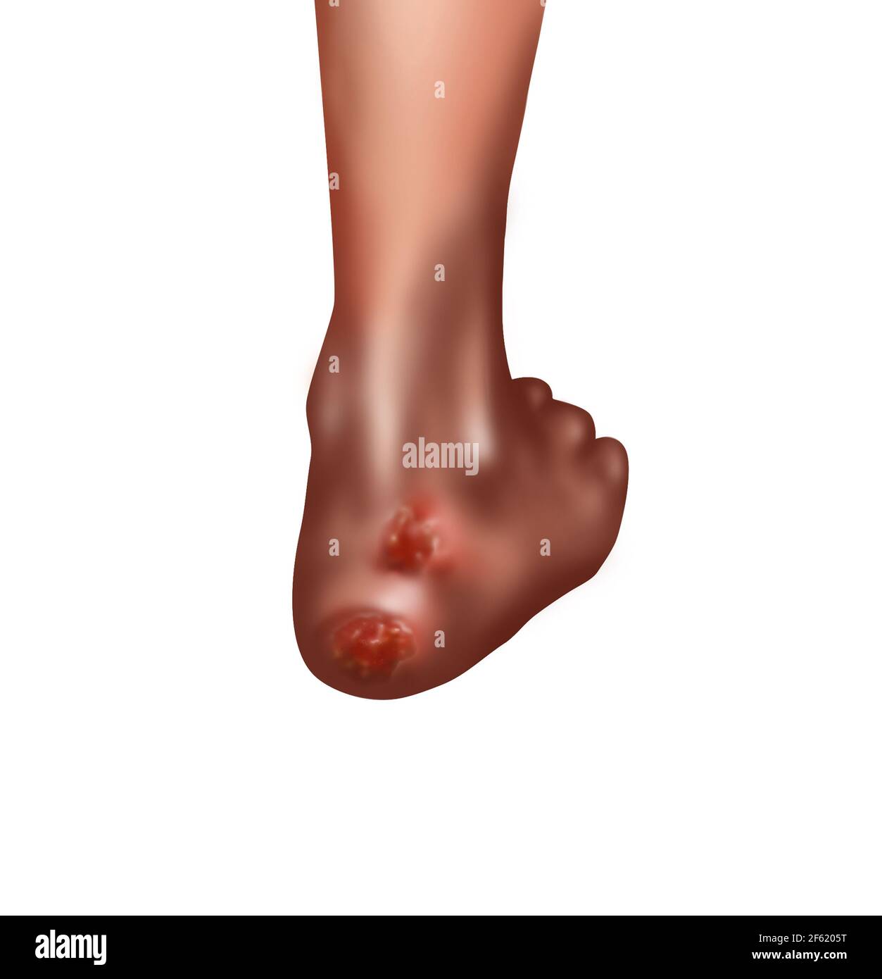 Bed Sores Stock Photo