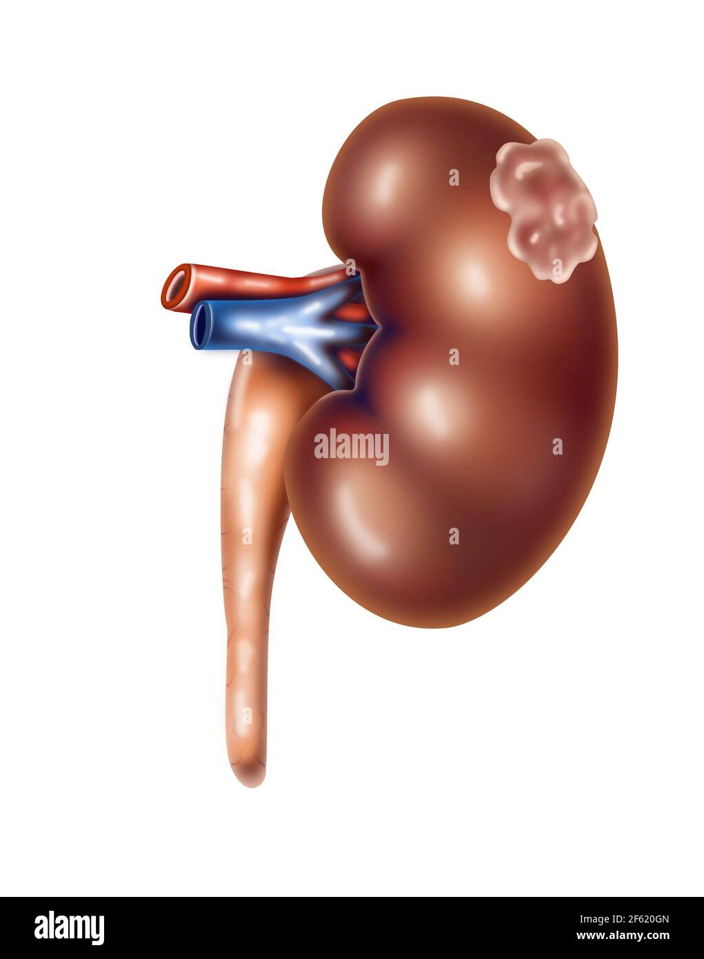 Kidney Cancer Stock Photo