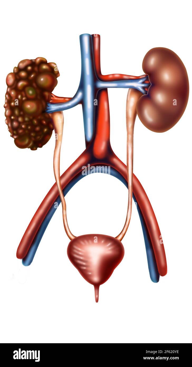 Polycystic Kidney Disease Stock Photo Alamy
