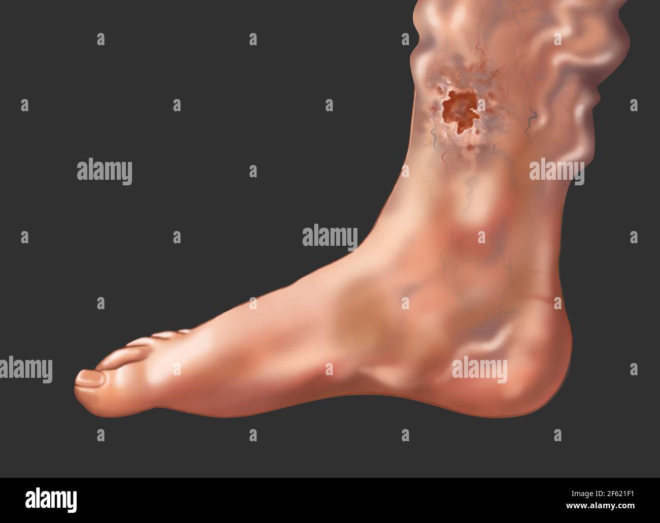 Skin Ulcer from a Varicose Vein on the Ankle Stock Photo