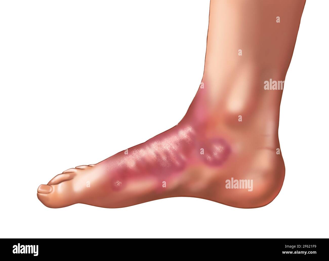 Psoriasis on the Foot Stock Photo