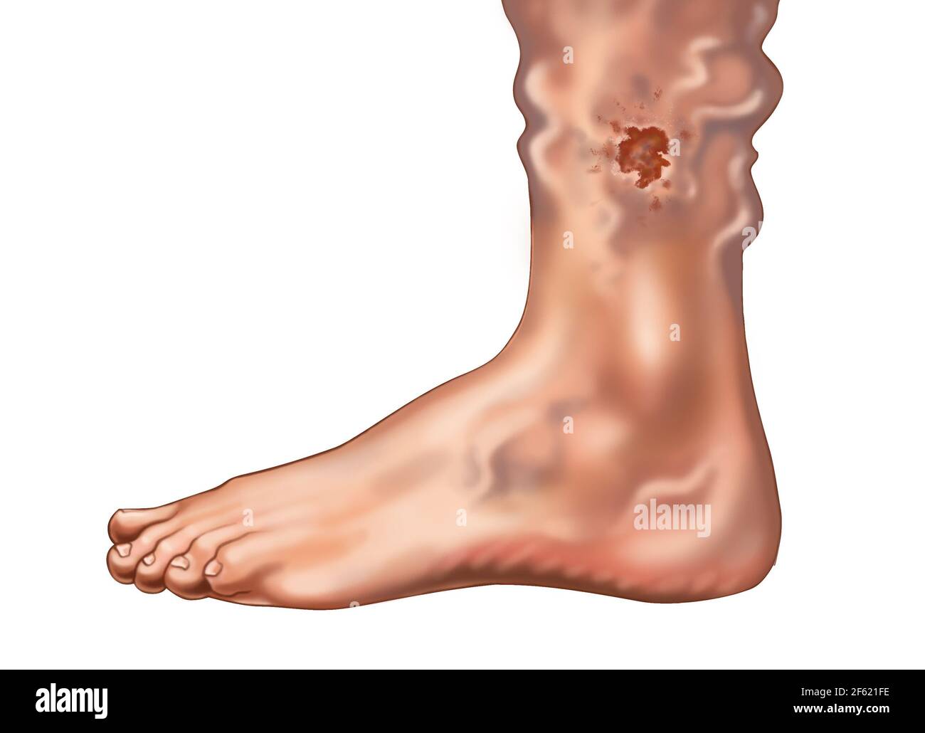 Skin Ulcer from a Varicose Vein on the Ankle Stock Photo