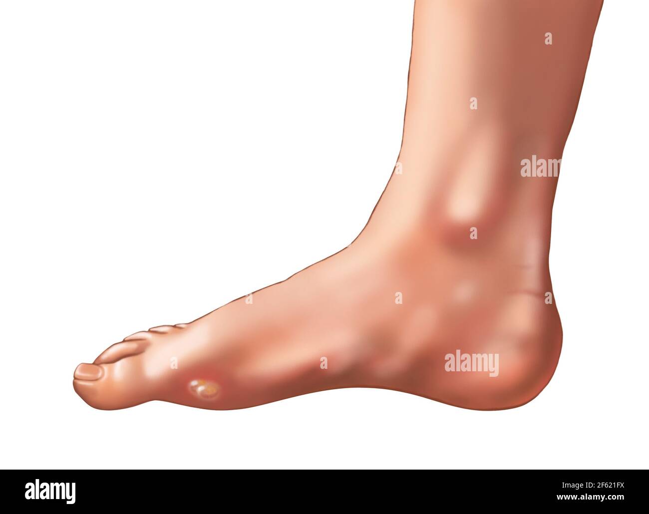 Blister on side of heel outlet