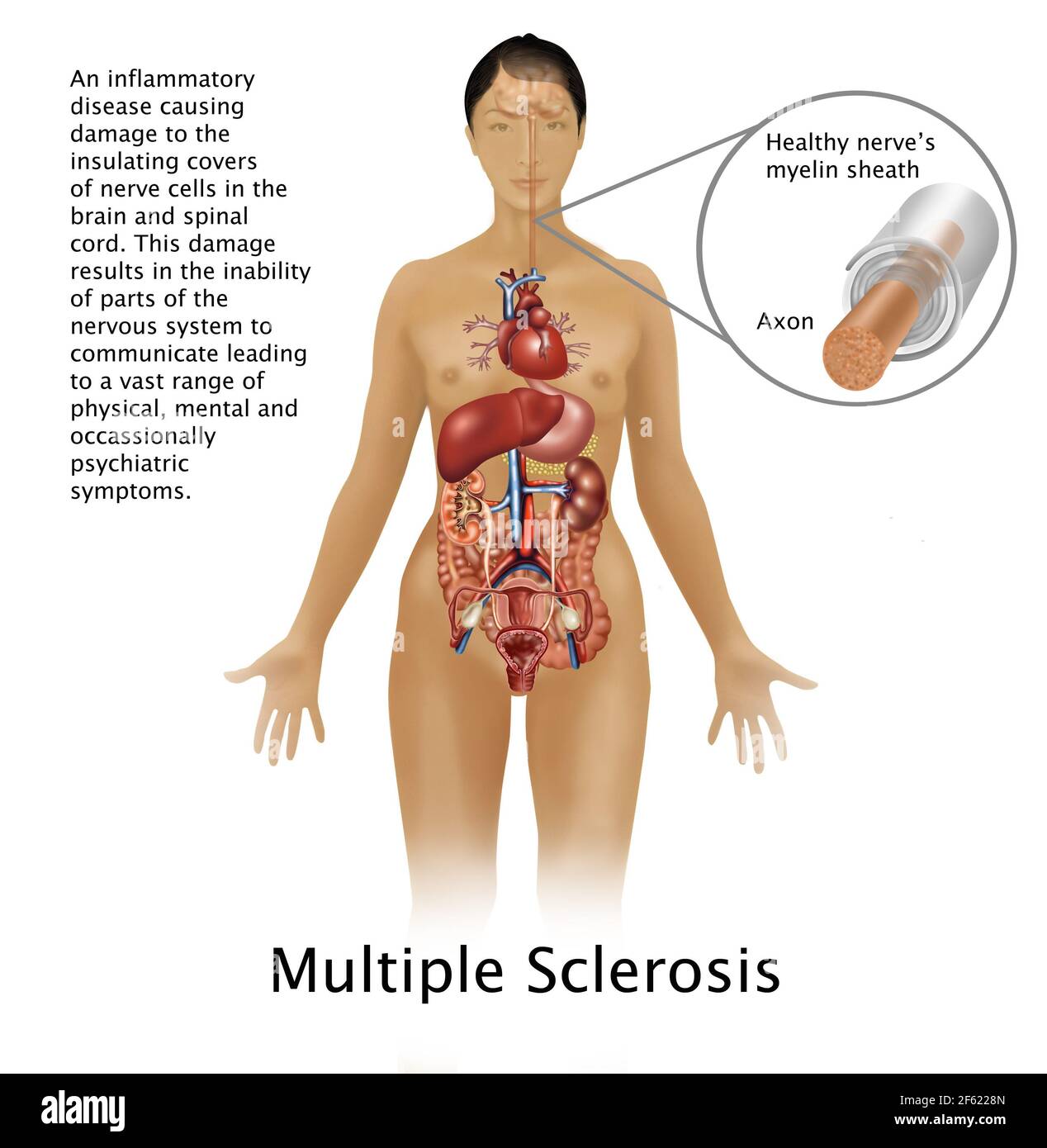 Multiple Sclerosis and Nerves Stock Photo