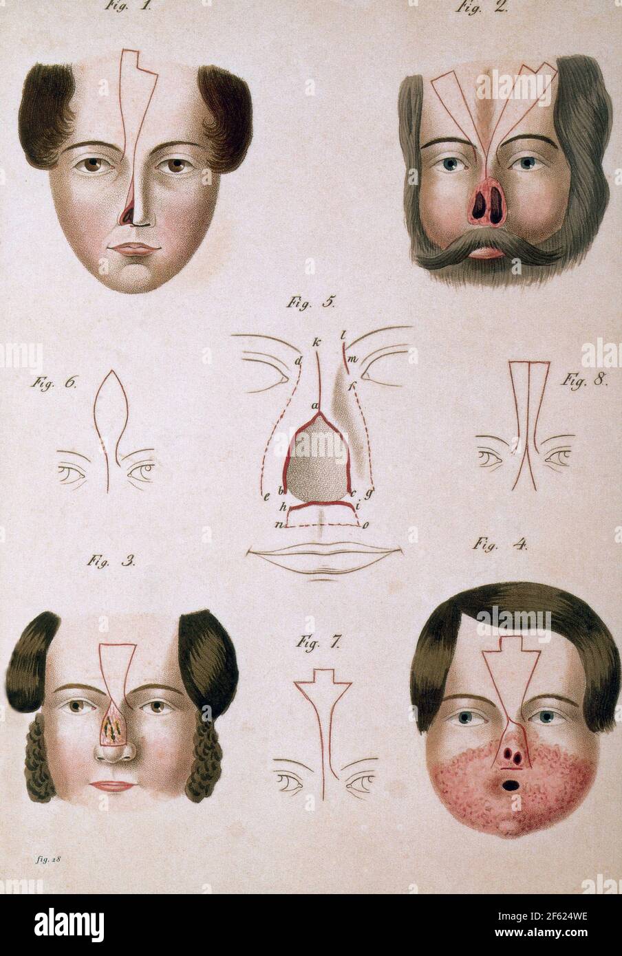 19th Century Facial Reconstruction Stock Photo