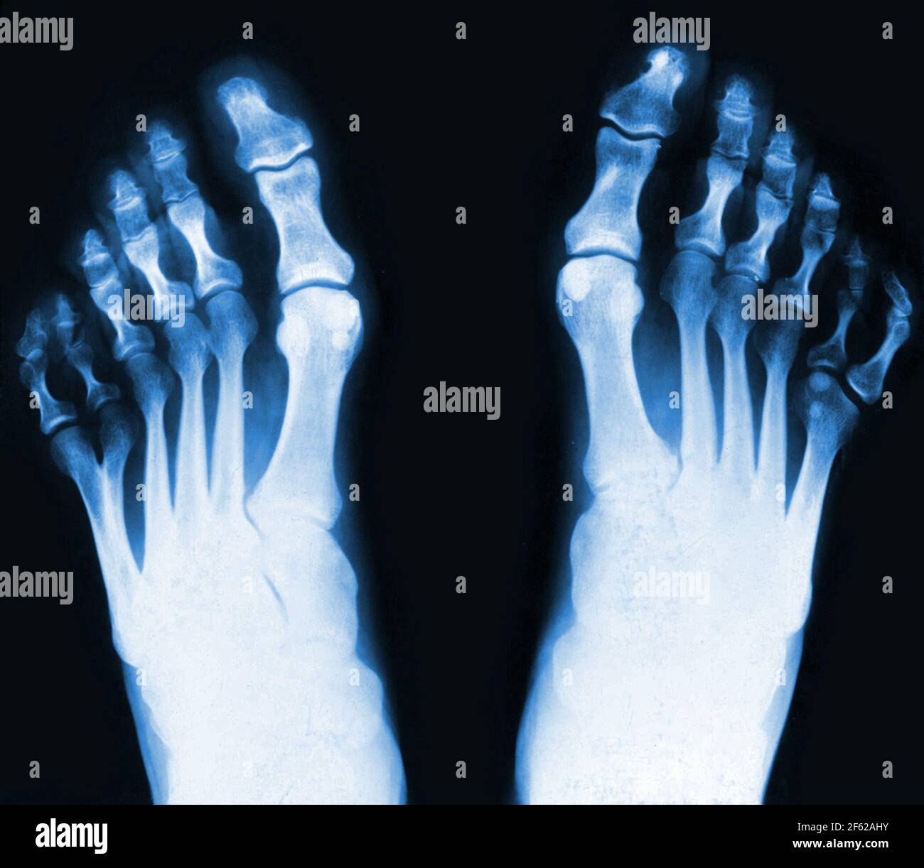 Polydactyly, Extra Toes, X-Ray Stock Photo
