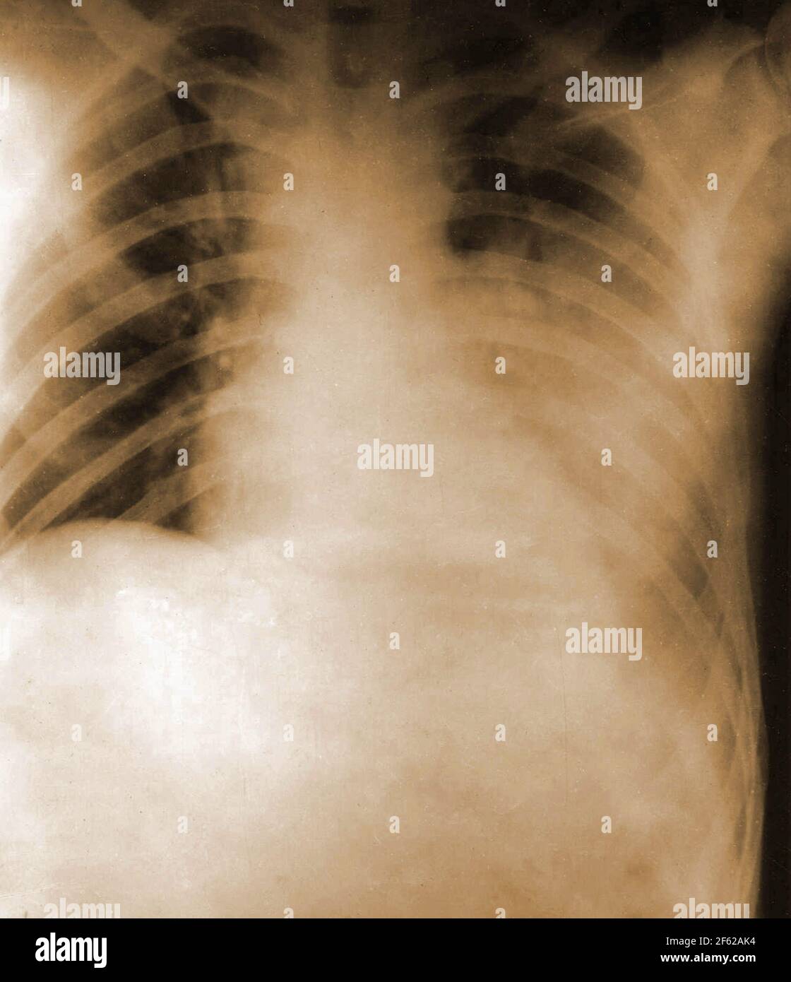 Spanish Flu, Chest XRay, 1918 Stock Photo Alamy