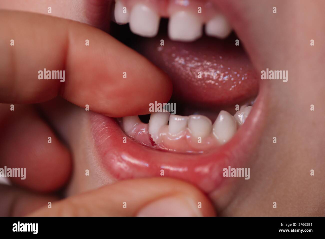 hand pulls out the first lower milk tooth, the process of changing temporary teeth, the roots of the tooth protrude from the wound in the gum Stock Photo