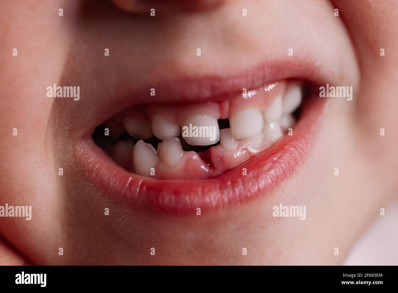 close-up macro wound in the gum from a fallen baby tooth in the mouth of a six-year-old child Stock Photo