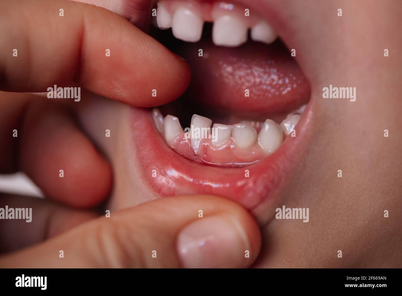 closeup of the lower row of children's teeth with one falling out baby