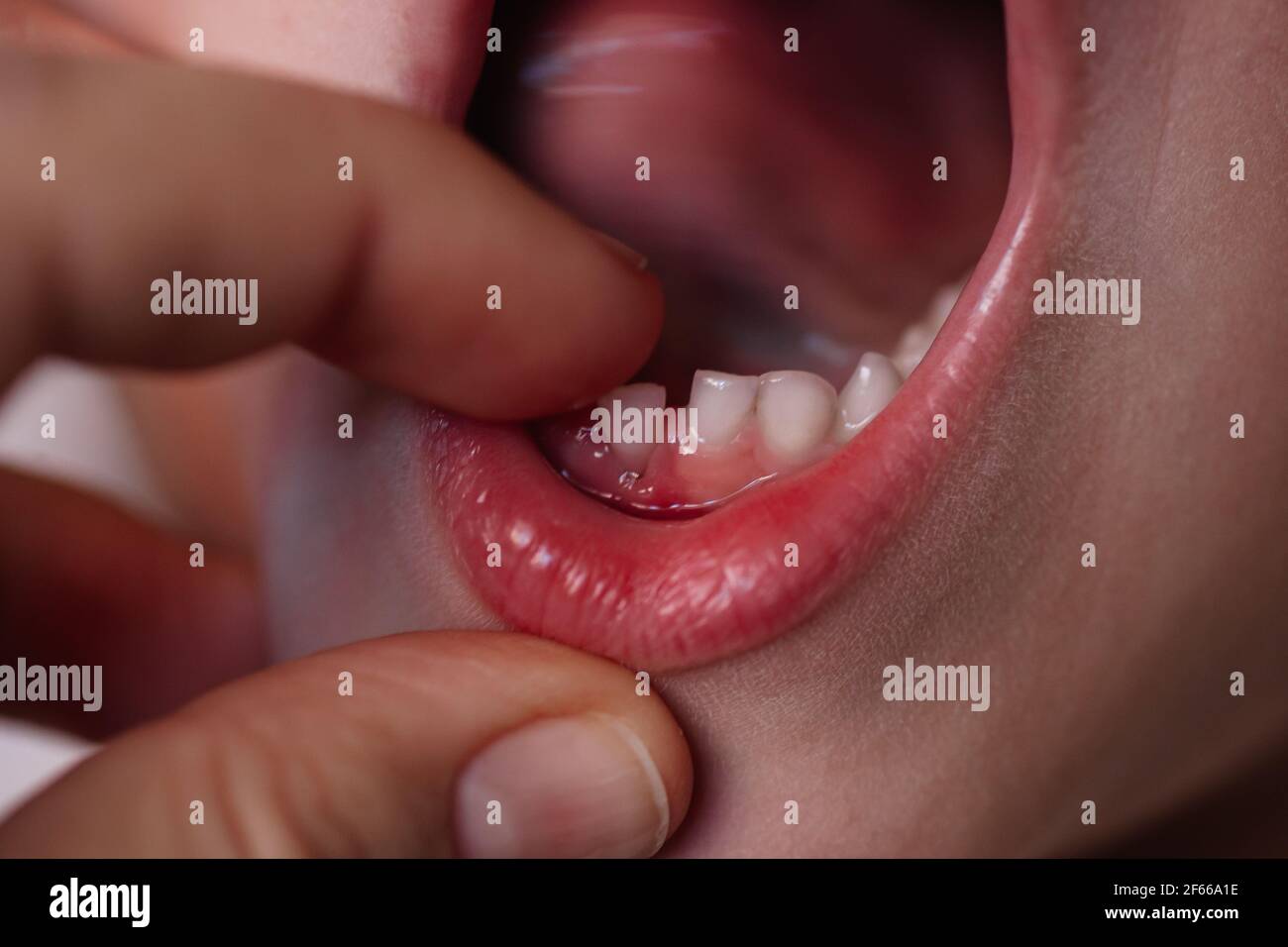 Temporary teeth hires stock photography and images Alamy