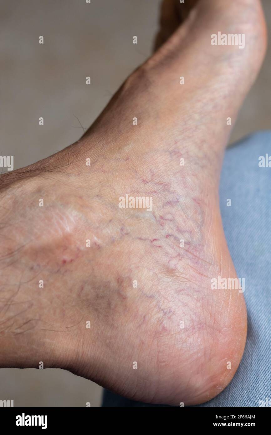 Adult man's foot with varicose veins Stock Photo