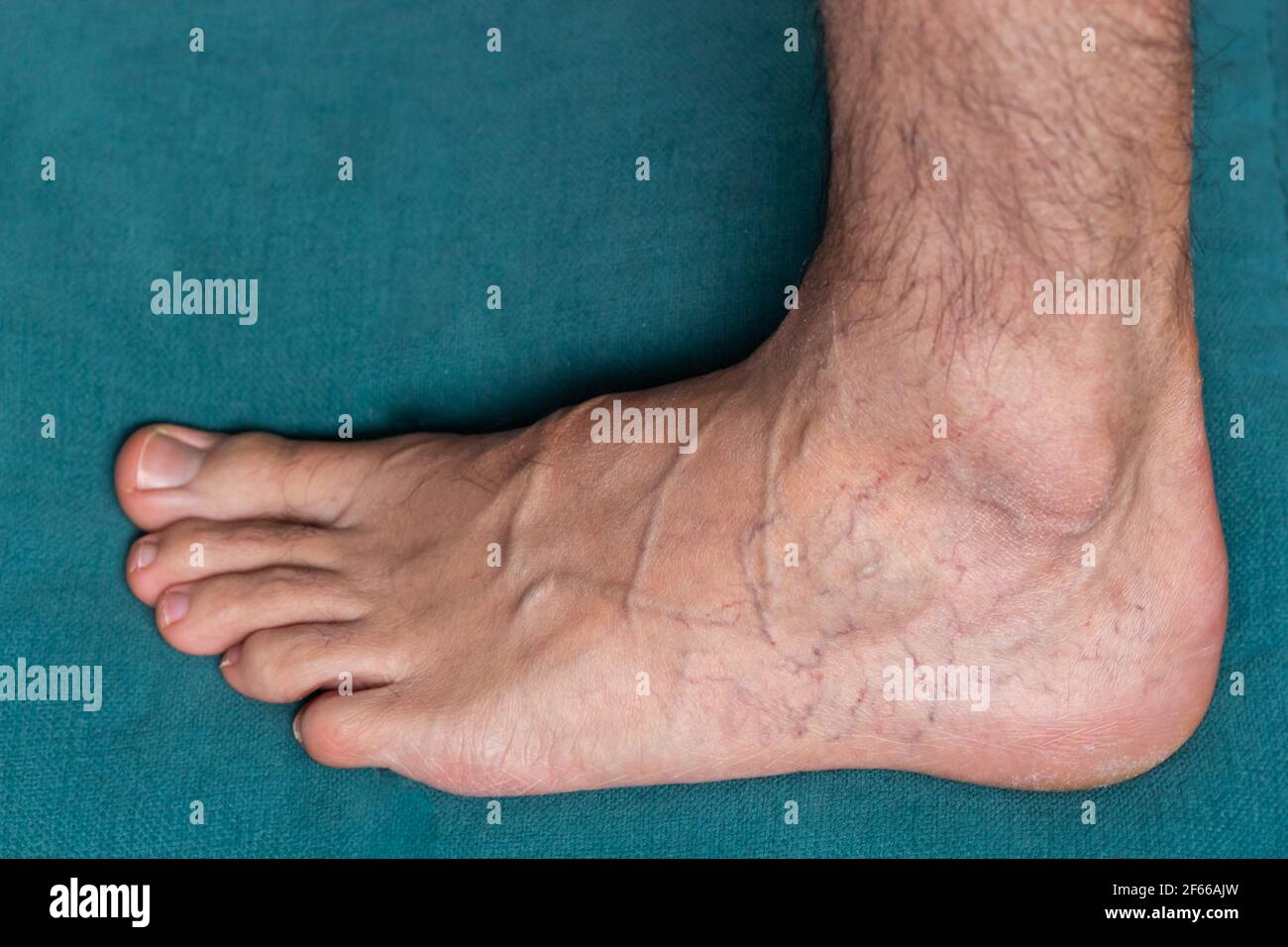 Adult man's foot with varicose veins Stock Photo