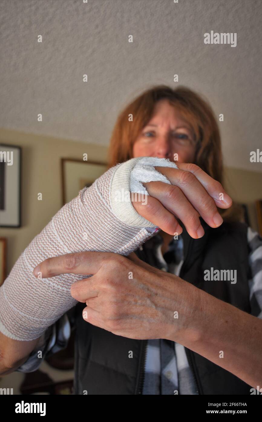 Woman with a stiff cast on her broken wrist which was repaired by