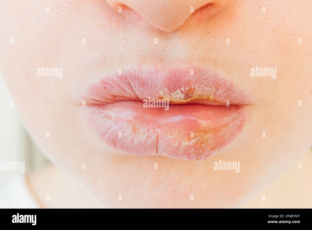 Close up of girl lips affected by herpes. Treatment of herpes infection