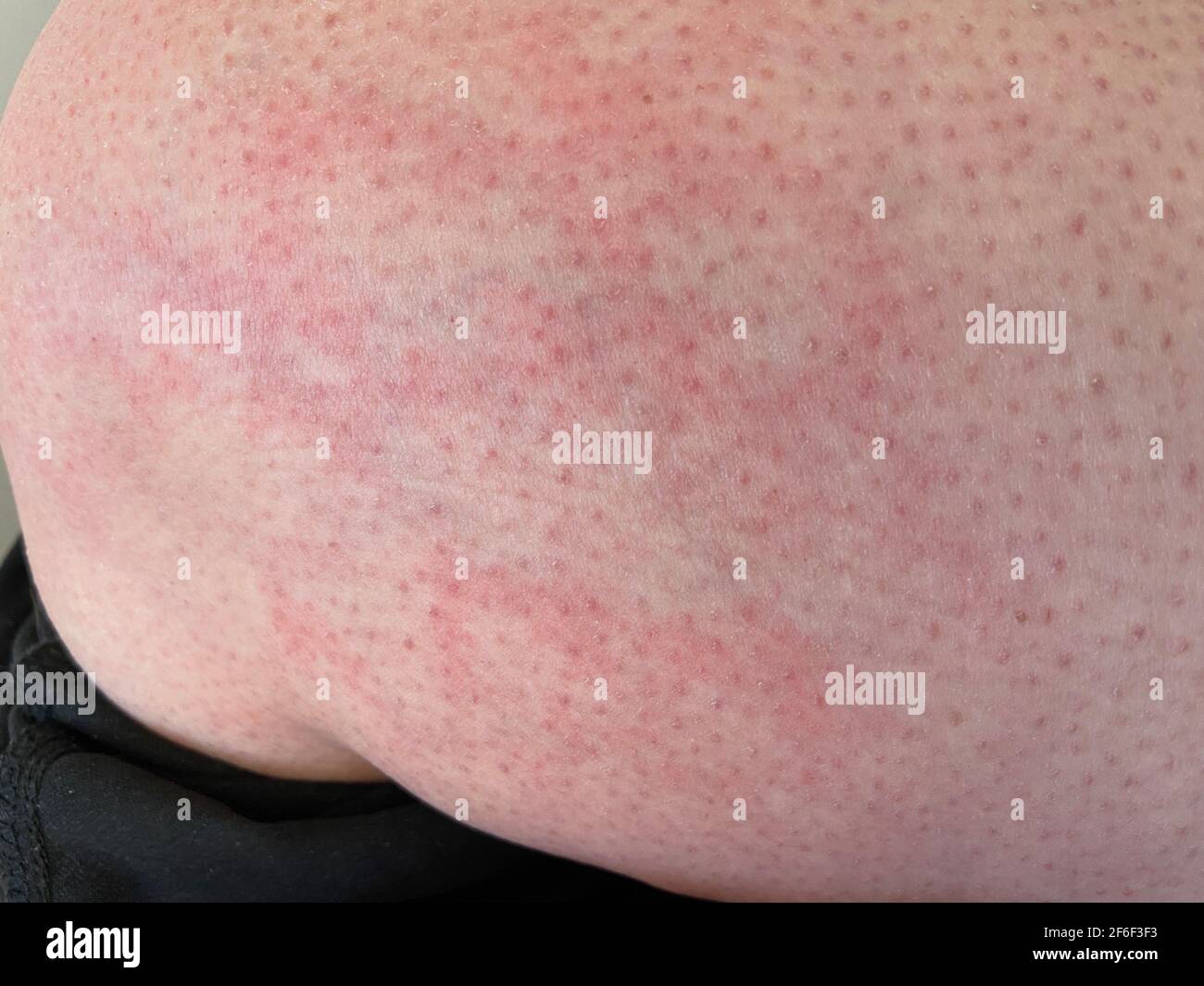 mottled skin heat rash hives allergy reaction on knee closeup