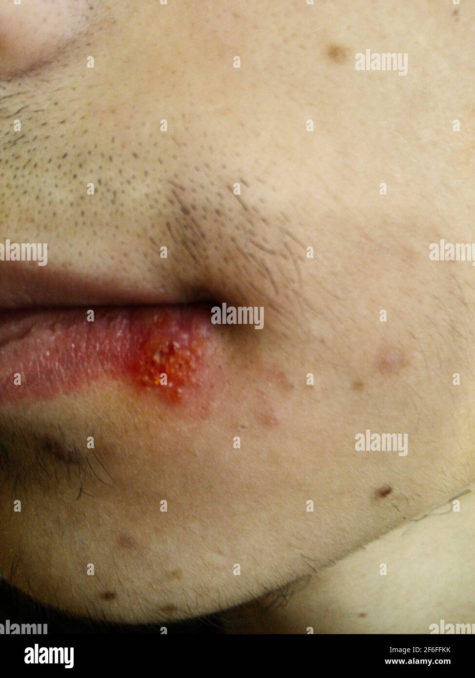Close-up of a teenager's mouth with herpes simplex Stock Photo