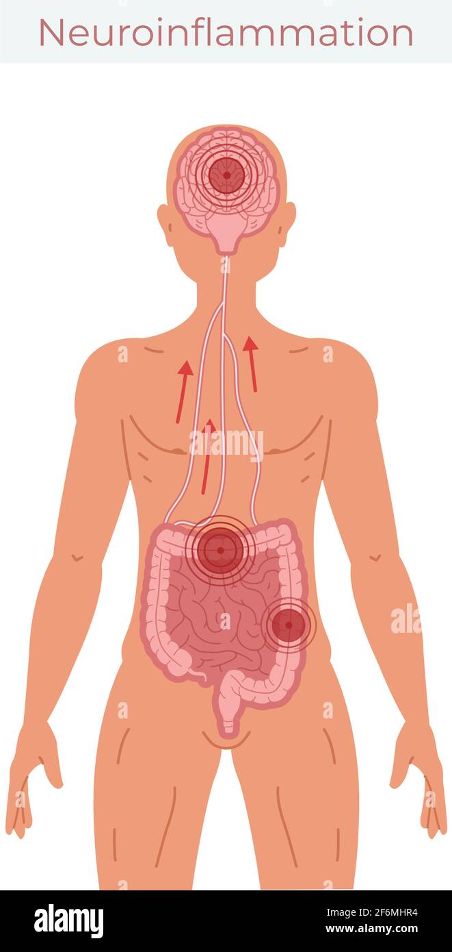 Poor gut health leads to neuroinflammation vector illustration. Stock Vector