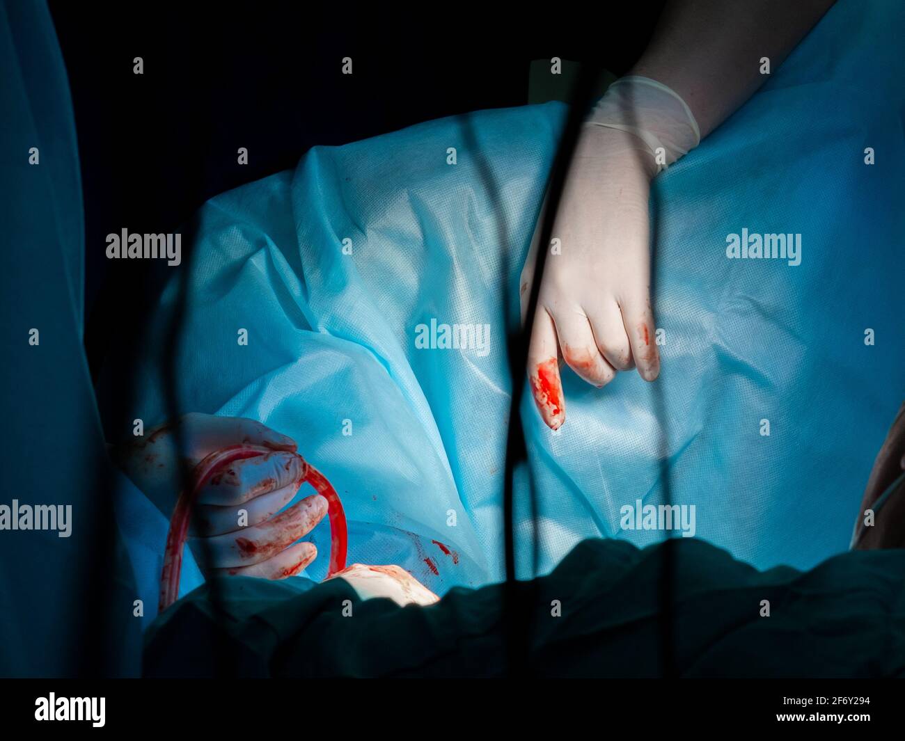 The bloody hands of surgeons in sterile gloves work with a medical