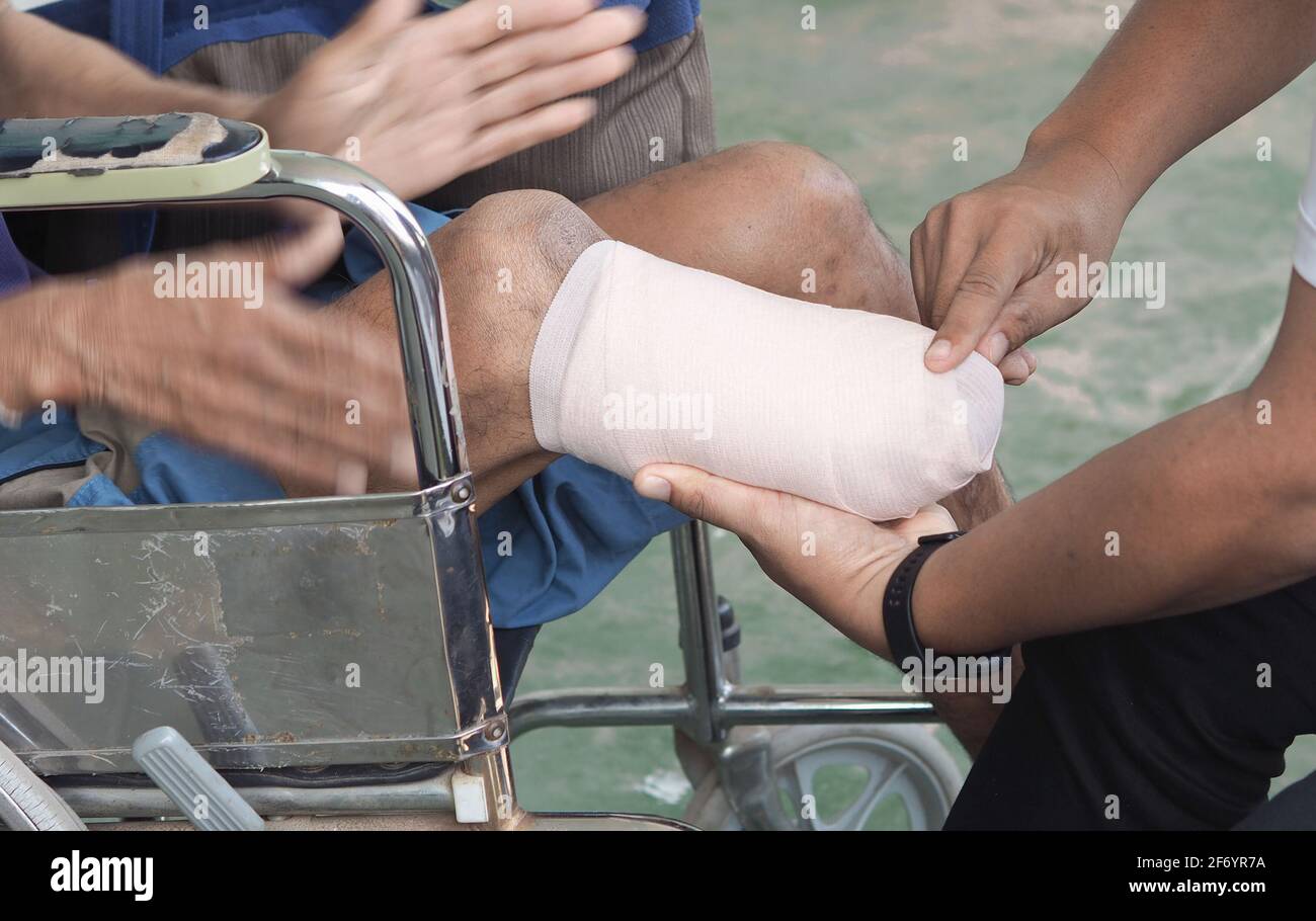 Elastic bandaged below knee amputation for prosthesis Stock Photo