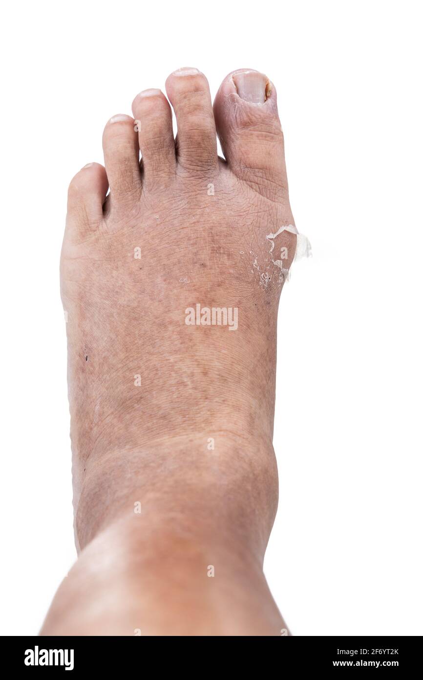 Gout Toe High Resolution Stock Photography and Images Alamy