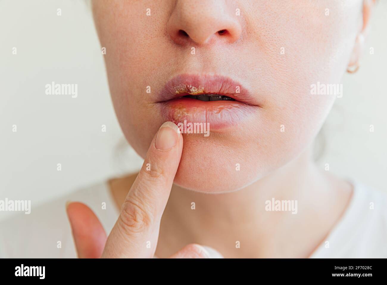 Close up of girl lips affected by herpes. Treatment of herpes infection and virus. Part of young